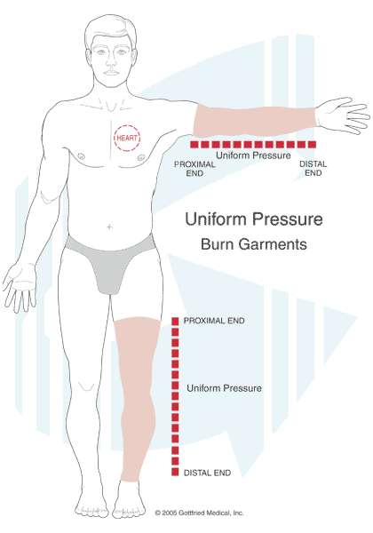 Uniform Pressure Garment - Compression Management Services® The Lymphedema  Centers